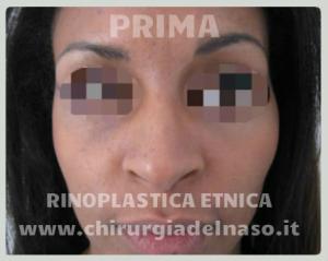 big_rinoplastica-etnica-prima-frontale_primadopo_8_Wuj7i.jpg