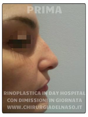 big_rinoplastica-in-day-hospital-foto-prima-1_primadopo_138_GOsG7.jpg