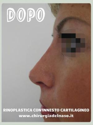 immagine post intervento di Rinoplastica con innesto di cartilagine prelevata dalla paziente
