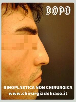 big_rinoplastica-non-chirurgica-dopo_primadopo_84_psPB2 (1).jpg