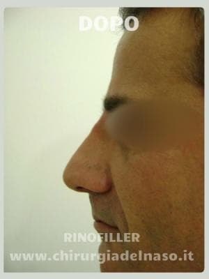 big_rinoplastica-non-chirurgica-post_primadopo_87_4lpIb (1).jpg