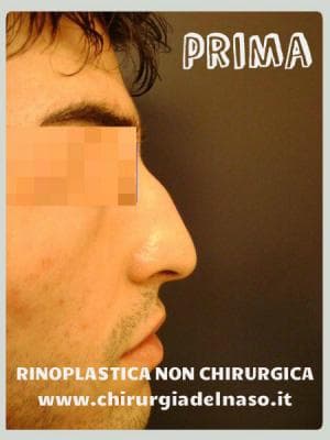 big_rinoplastica-non-chirurgica-prima_primadopo_84_AYneY (1).jpg