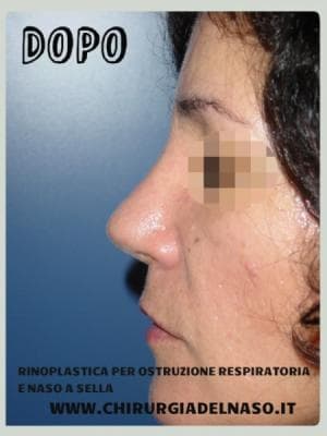 Rinoplastica per correggere ostruzione nasale
