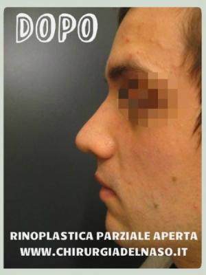 big_RINOPLASTICA-PARZIALE-APERTA-FOTO-DOPO-PROFILO1_primadopo_24_iaMcO.jpg