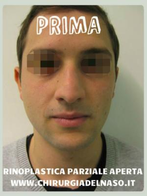 big_RINOPLASTICA-PARZIALE-APERTA-FOTO-PRIMA-FRONTALE1_primadopo_24_C83Sw.jpg