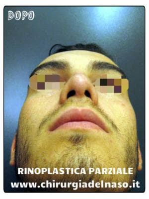 big_rinoplastica-parziale-dopo-frontale-basso_primadopo_22_Cqfvk (1).jpg