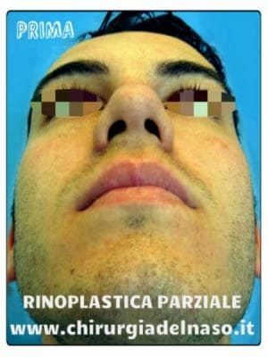big_rinoplastica-parziale-prima-frontale-basso_primadopo_22_7KmRq (1).jpg