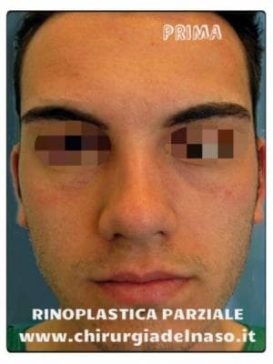 big_rinoplastica-parziale-prima-frontale_primadopo_22_dvvwF (1).jpg