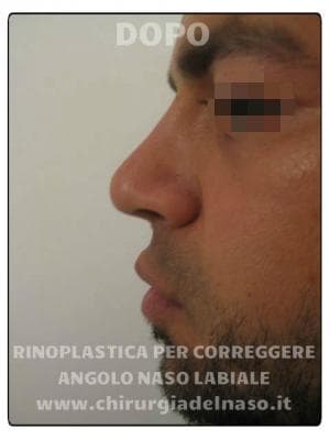 big_rinoplastica-per-correggere-angolo-naso-labiale-foto-dopo_primadopo_142_5qc98 (1).jpg