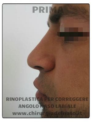 big_rinoplastica-per-correggere-angolo-naso-labiale-foto-prima_primadopo_142_dYp1J (1).jpg