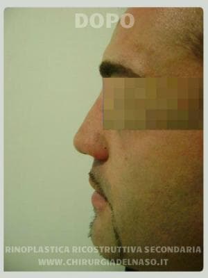 Rinosettoplastica ricostruttiva con tecnica aperta