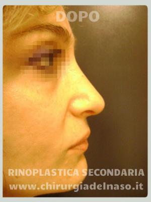 big_rinoplastica-secondaria-dx-post_primadopo_75_2Tlie.jpg