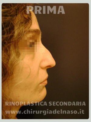 big_rinoplastica-secondaria-dx-pre_primadopo_75_URbs3.jpg