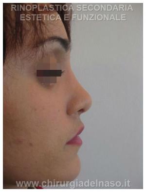Foto profilo naso dopo rinoplastica per motivi estetici e funzionali