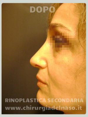 Foto esito Rinoplastica per correggere gibbo e punta