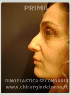 big_rinoplastica-secondaria-sx-pre_primadopo_75_drZXz.jpg