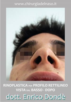 big_RinoplasticaBasso-Dopo_primadopo_210_p7Cwi.jpg