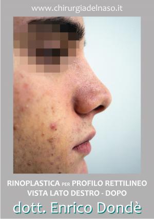 Rinoplastica estetica maschile