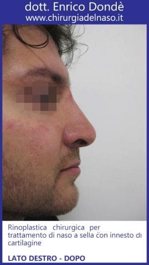 Rinoplastica con innesto dorsale con cartilagine propria