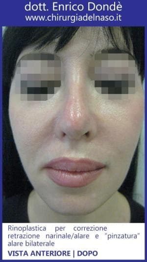 Rinoplastica per correggere retrazione narinale/alare e pinzatura alare bilaterale del naso