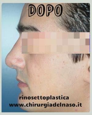 Foto profilo naso dopo intervento settoplastica 