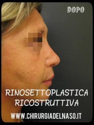 big_rinosettoplastica-ricostruttiva-profilo-dopo_primadopo_21_iuOW2 (1).jpg