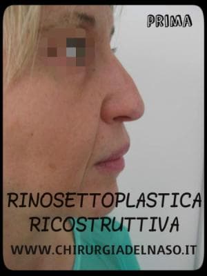 big_rinosettoplastica-ricostruttiva-profilo-prima_primadopo_21_vpSC0 (1).jpg