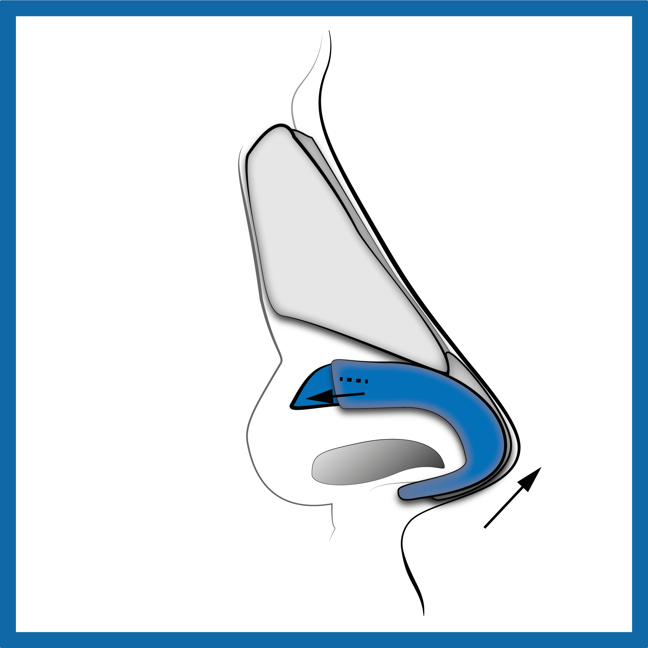 LATERAL-CRURAL OVERLAY_post-profilo-destro.png