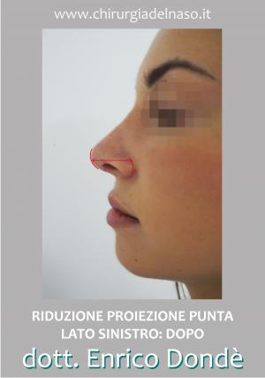 RiduzioneProiezionePunta-SinDopo-freccia.jpg