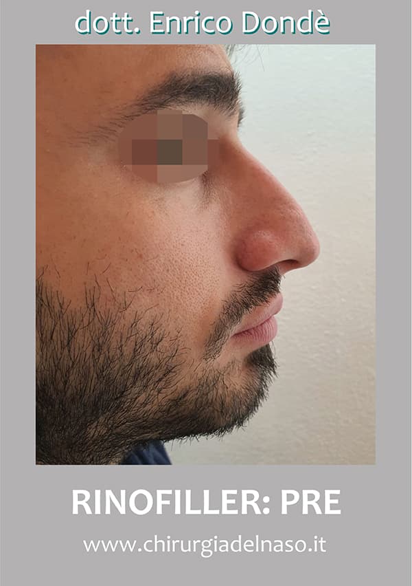 Rinofiller01-pre.jpg