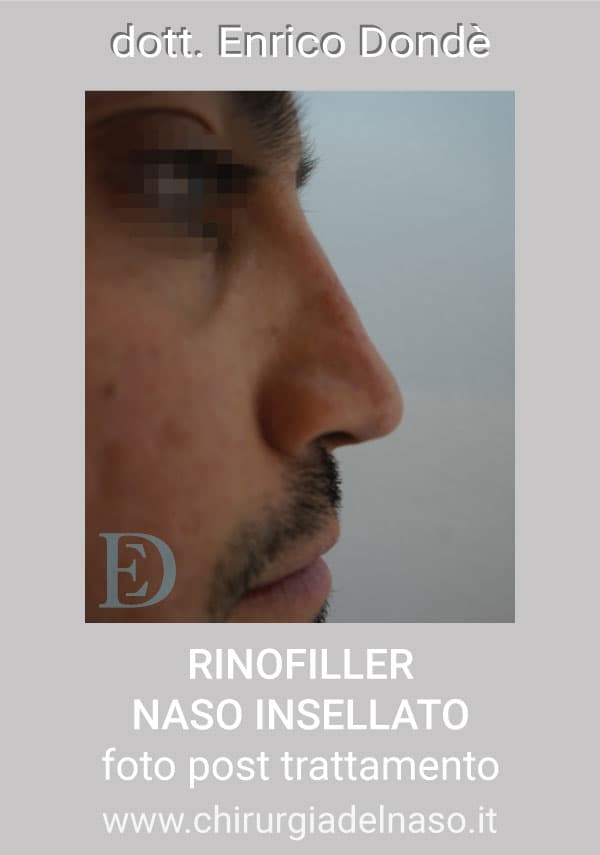 RinofillerNasoInsellato-post01.jpg