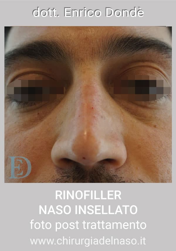 RinofillerNasoInsellato-post02.jpg