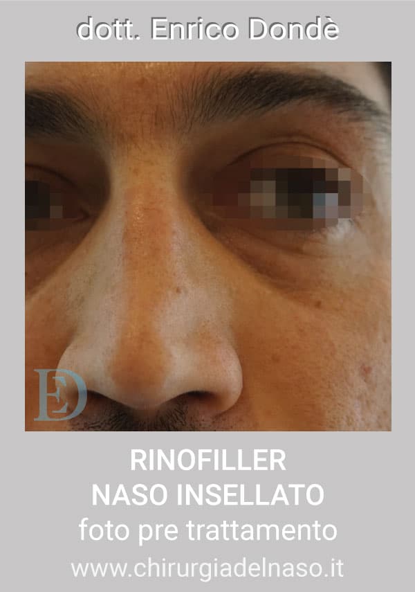 RinofillerNasoInsellato02.jpg