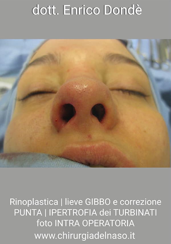 Rinoplastica-intra-01.jpg