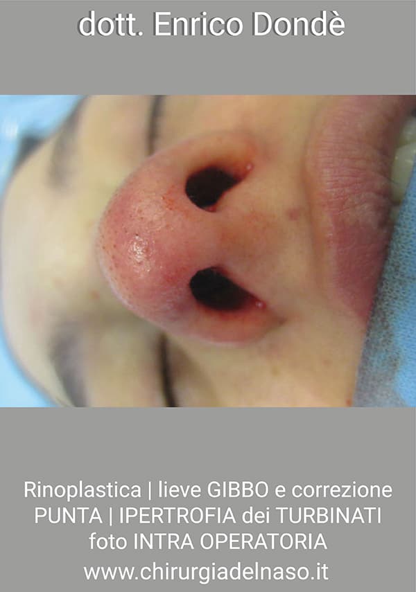Rinoplastica-intra-03.jpg