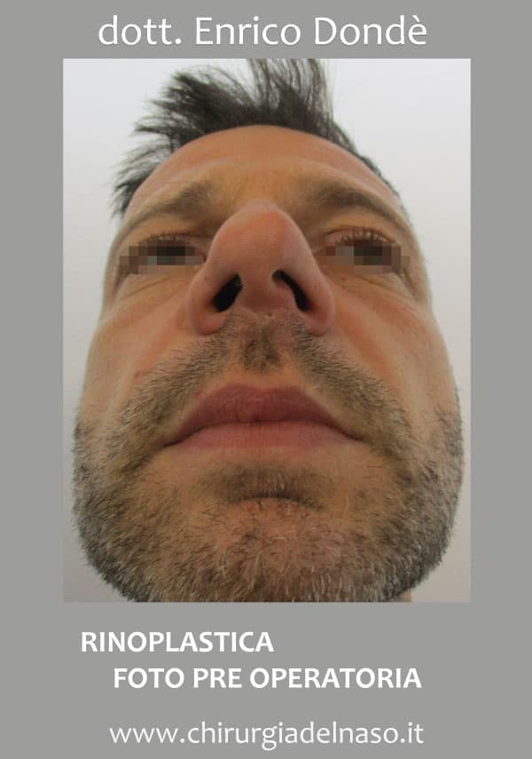 Rinoplastica-secondaria-01.jpg