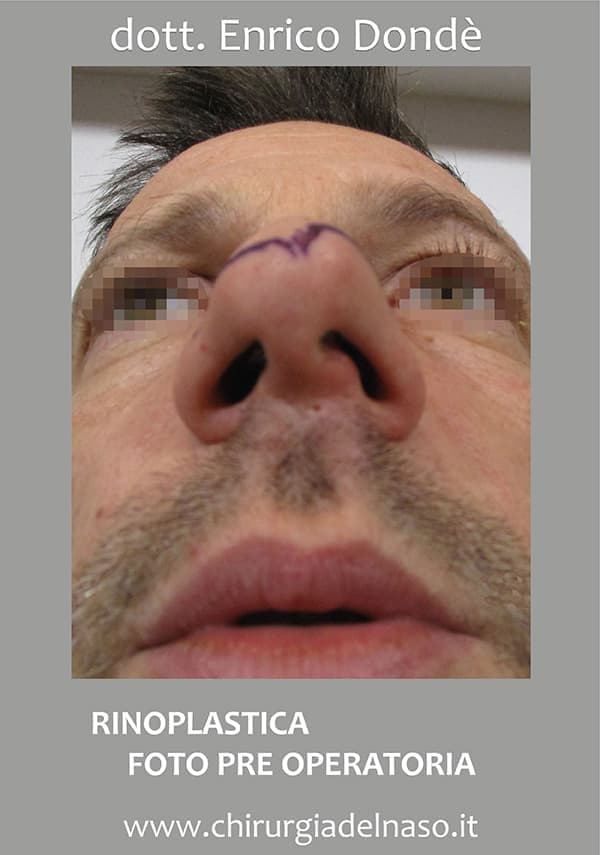 Rinoplastica di ritocco - foto pre operatoria