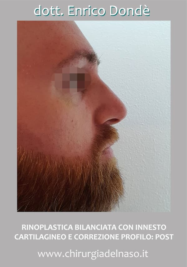 Rinoplastica maschile con innesto cartilagineo