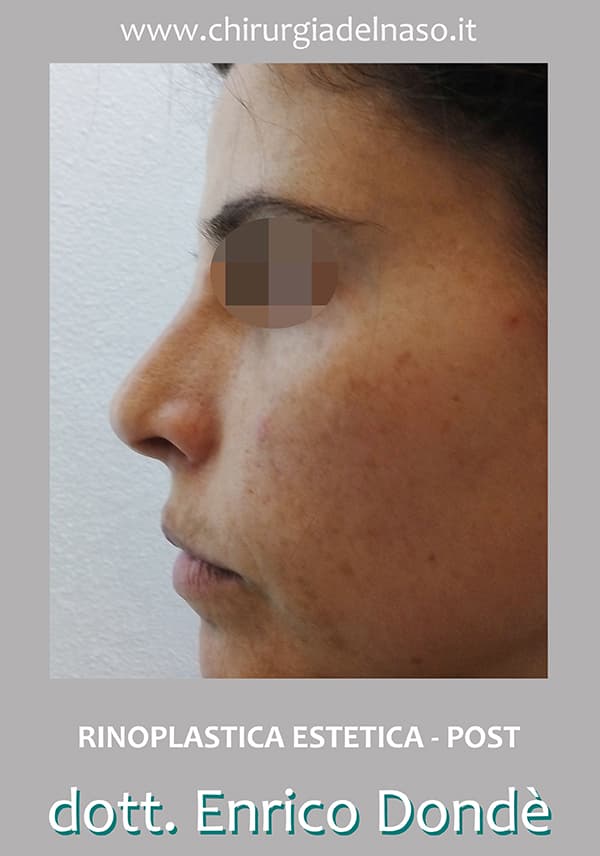Rinoplastica per correzione del profilo