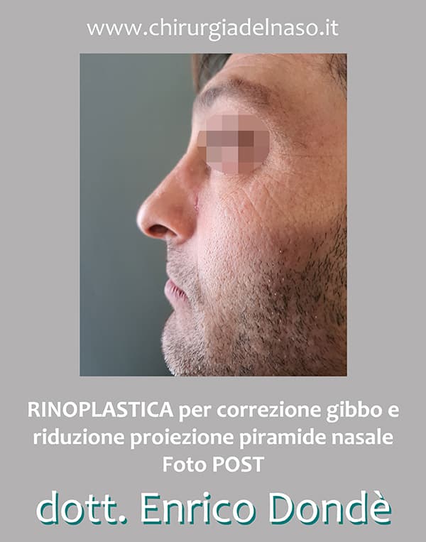 Rinoplastica estetica con riduzione della punta