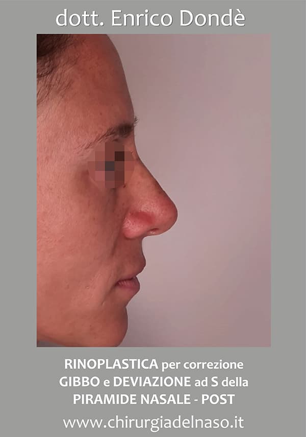 Correzione gibbo e piramide nasale con rinoplastica
