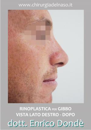 Rinoplastica uomo per gibbo