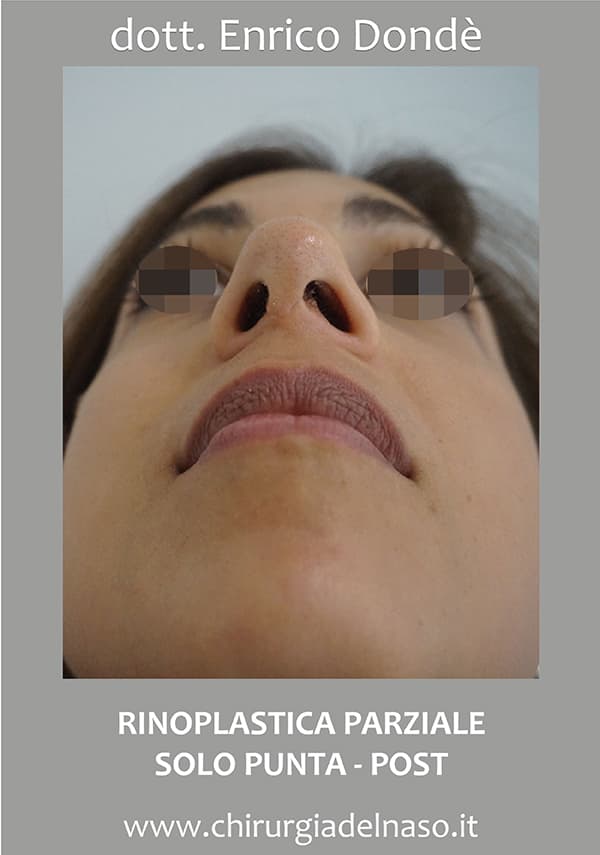 RinoplasticaParzialeSoloPunta-post02.jpg