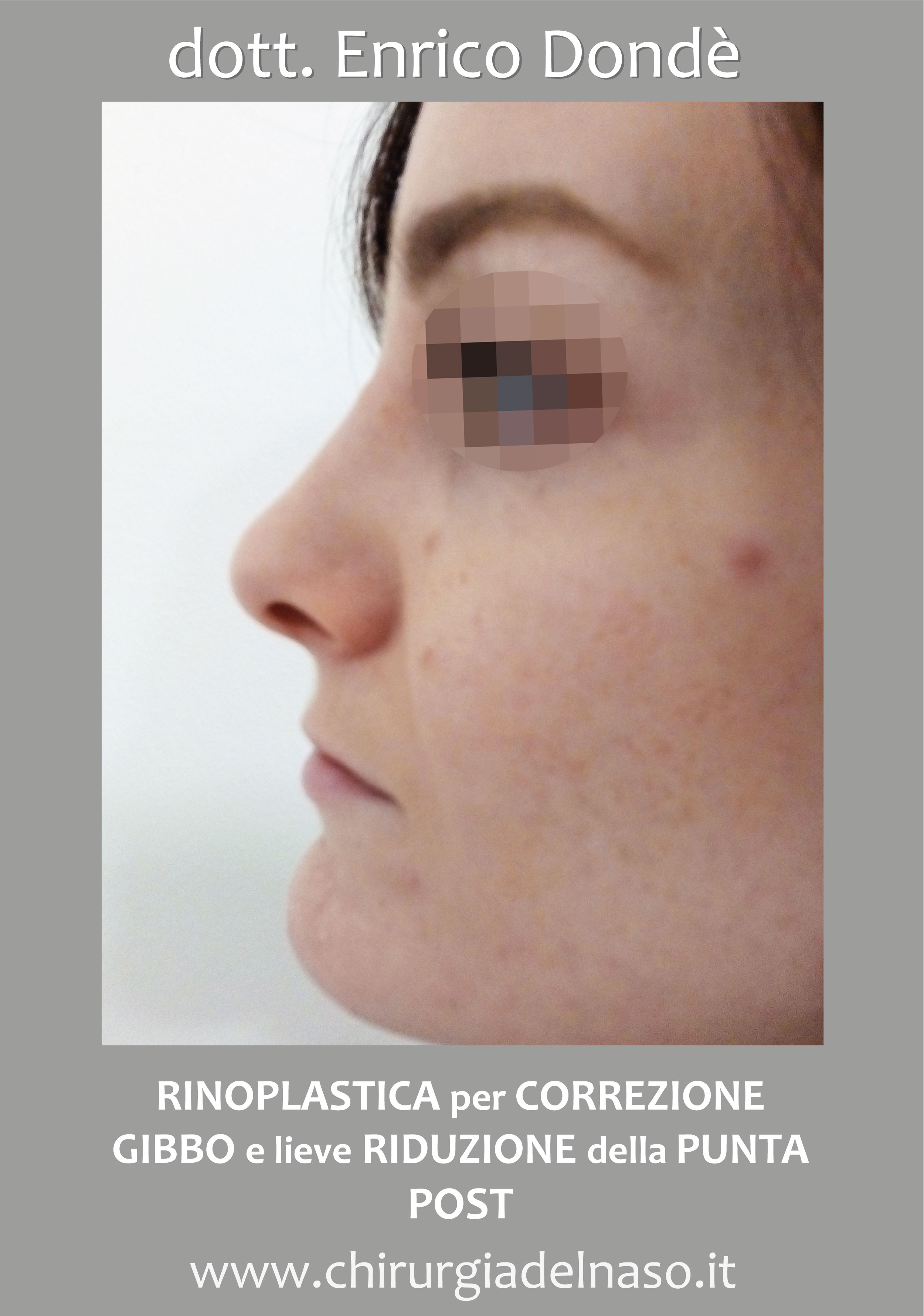 Correzione gibbo e riduzione del volume della punta