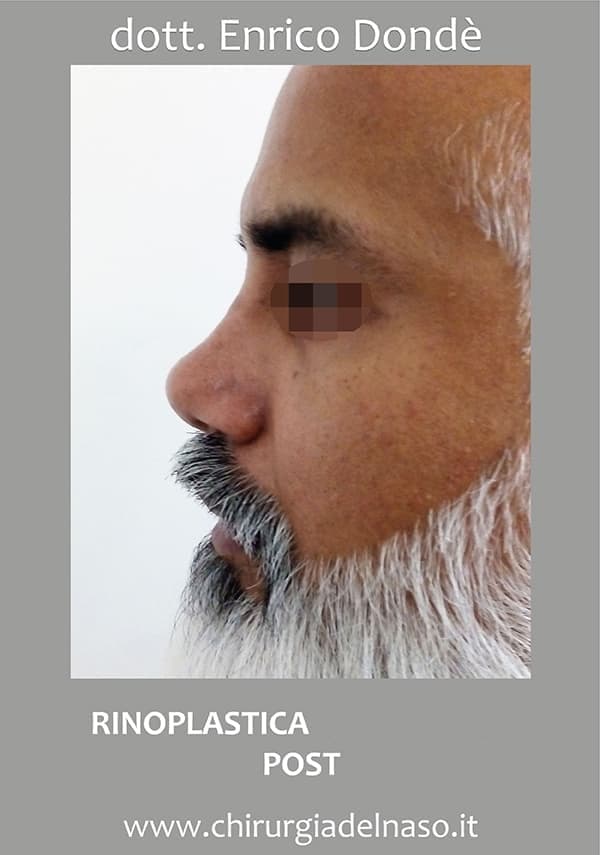 RinoplasticaSecondaria-post01.jpg