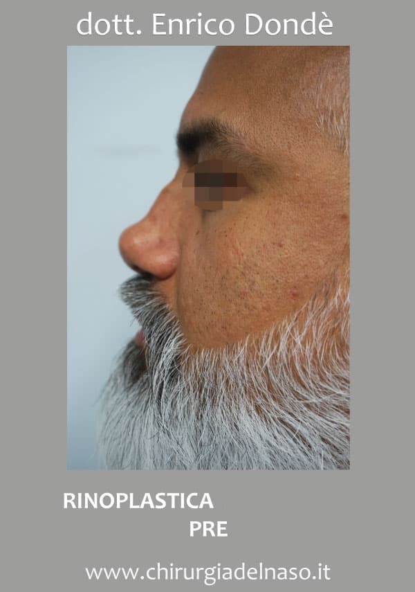 RinoplasticaSecondaria-pre01.jpg
