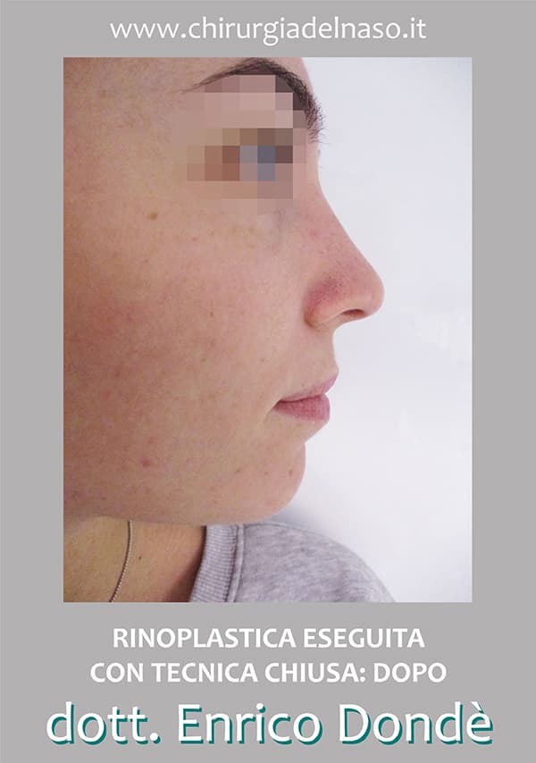 Rinoplastica con foto PRE e POST