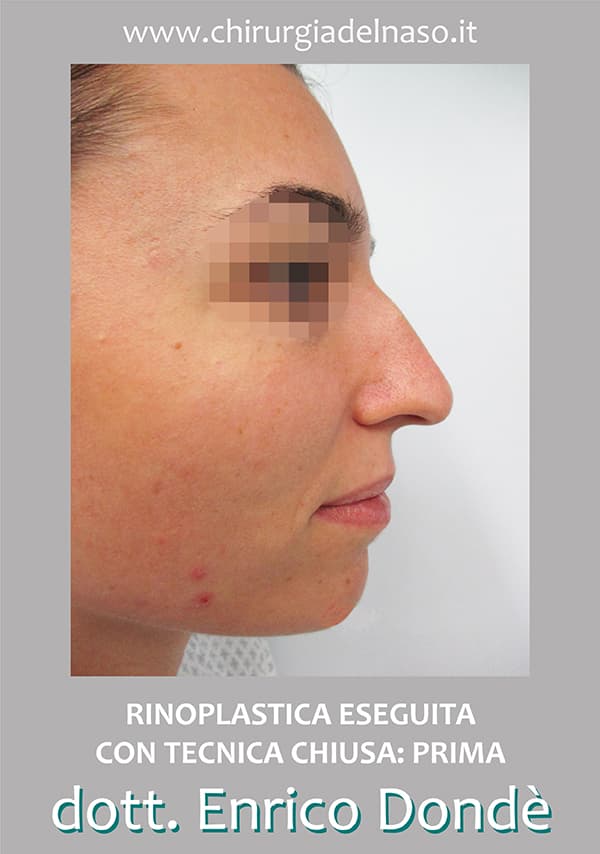 RinoplasticaTecnicaChiusa-PRE.jpg