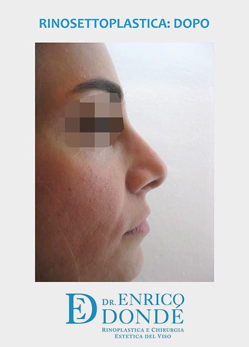Settoplastica e decongestione dei turbinati inferiori