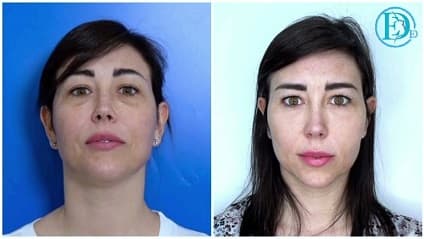 Foto prima e dopo trattamento con fili di trazione occhi e sopracciglio